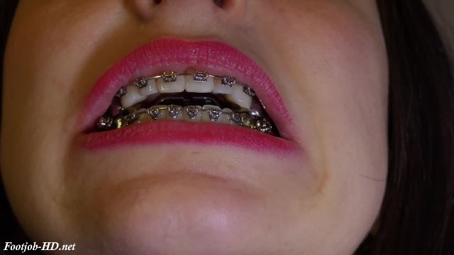 - Braces HERBST And Sandal Shoejob 00002 Braces HERBST And Sandal Shoejob - 00002